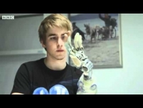 Amputee Patrick demonstrates his new worlds first bionic hand